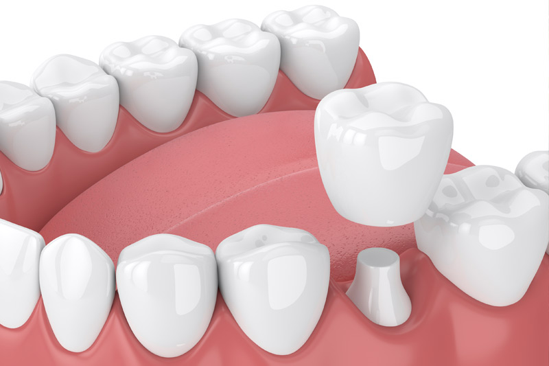 Dental Crowns in Jacksonville