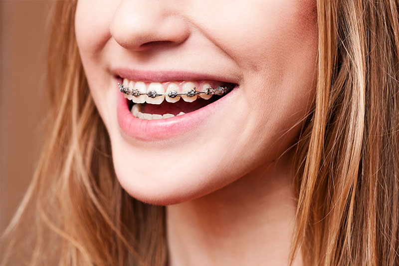 Orthodontics in Naples