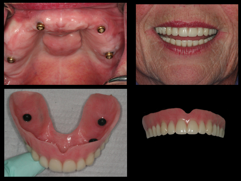 Snap on Dentures in Covina