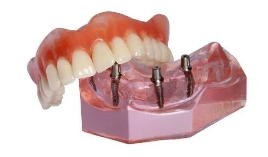 Snap on Dentures in Covina