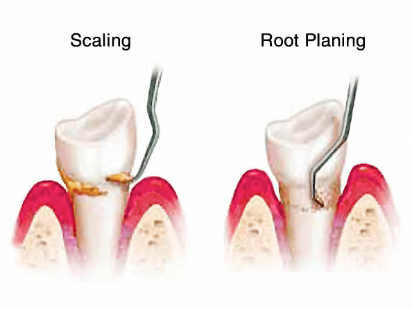 Scaling and Root Planing in Covina