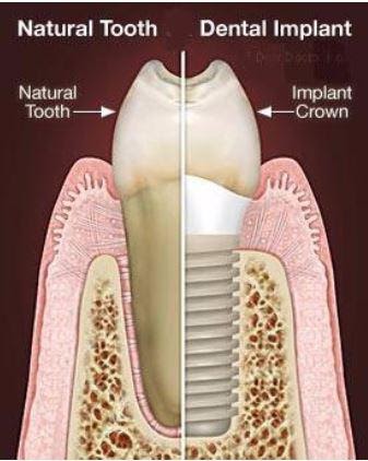 Single Unit Implant in Covina