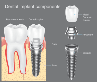 Single Unit Implant in Covina