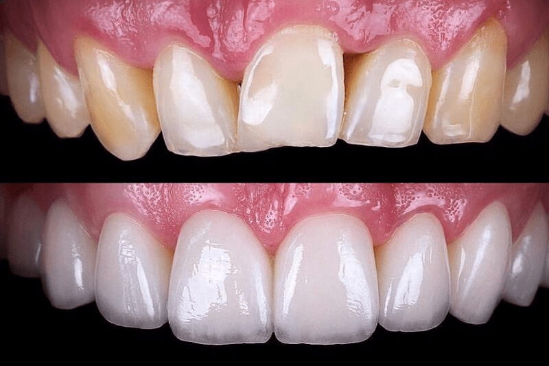 Veneers in Covina