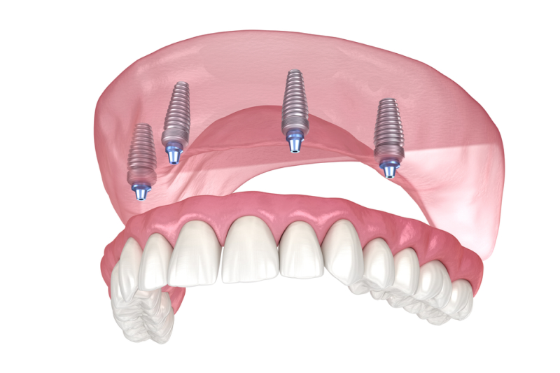 Emergency Dentist in West Covina