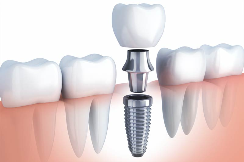 Dental Treatments in West Covina