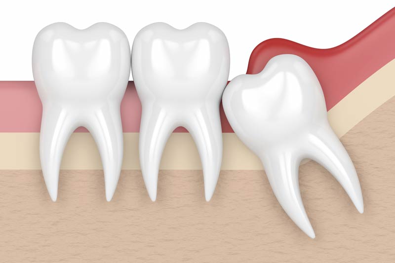 Wisdom Tooth Removal in Santa Maria