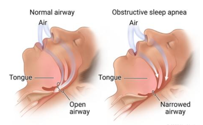 Dental Sleep Medicine in Petawawa