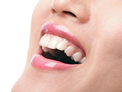 Dental Crowns in Alhambra