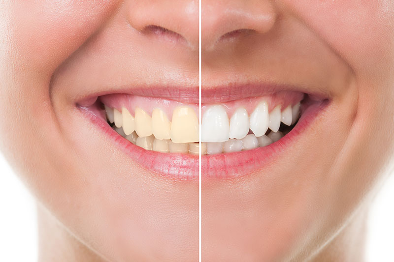 Teeth Whitening - Smile League Dental, Joliet Dentist
