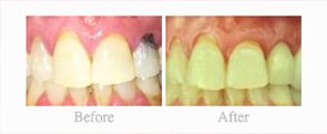 Before & After - 	Belva Dental, Daly City Dentist