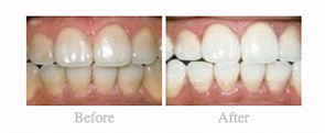 Before & After - 	Belva Dental, Daly City Dentist