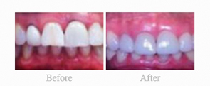 Before & After - 	Belva Dental, Daly City Dentist