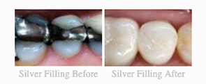 Before & After - 	Belva Dental, Daly City Dentist