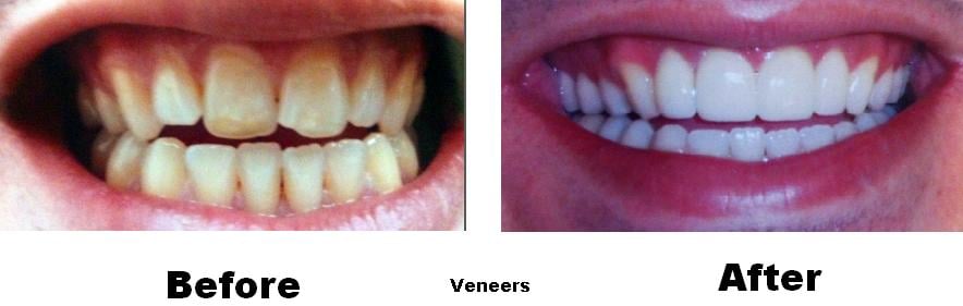 Before & After - 	Belva Dental, Daly City Dentist