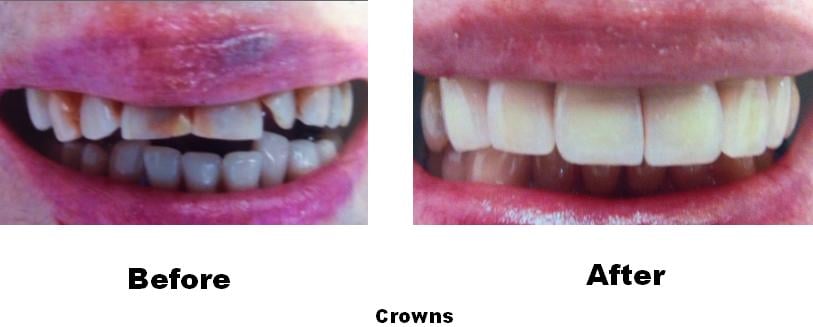 Before & After - 	Belva Dental, Daly City Dentist