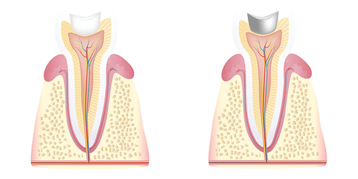 Composite vs Amalgam Fillings - The Center for High Tech Dentistry, New York Dentist