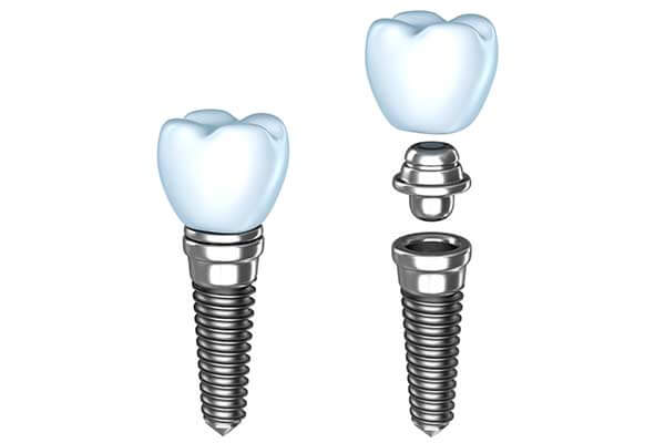 Dental Implants - The Center for High Tech Dentistry, New York Dentist