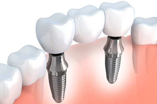 Dental Implants - The Center for High Tech Dentistry, New York Dentist