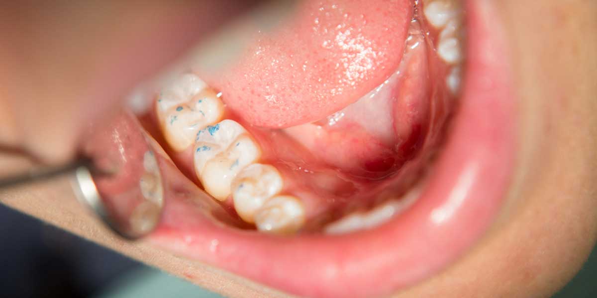 Occlusal Bite Adjustment - The Center for High Tech Dentistry, New York Dentist