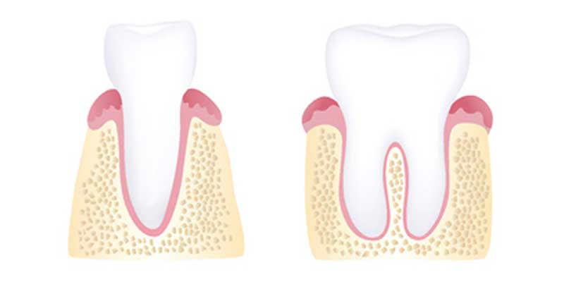 The Stages of Periodontal Disease - The Center for High Tech Dentistry, New York Dentist