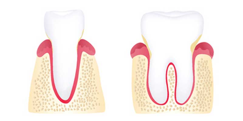 The Stages of Periodontal Disease - The Center for High Tech Dentistry, New York Dentist