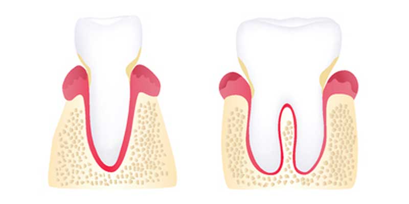 The Stages of Periodontal Disease - The Center for High Tech Dentistry, New York Dentist