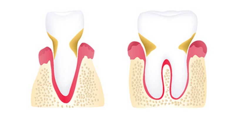 The Stages of Periodontal Disease - The Center for High Tech Dentistry, New York Dentist