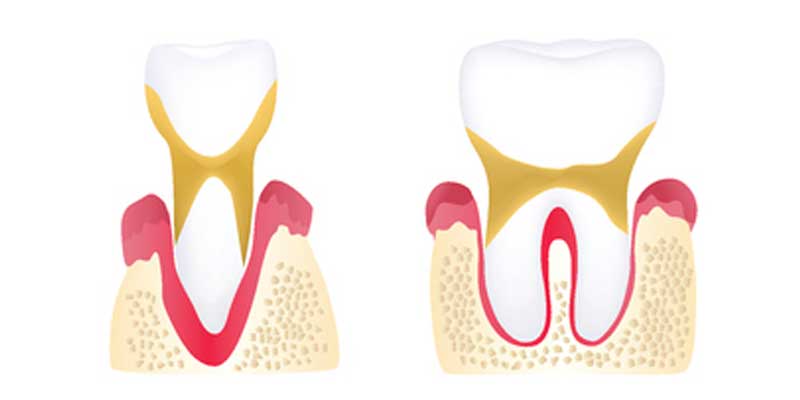 The Stages of Periodontal Disease - The Center for High Tech Dentistry, New York Dentist