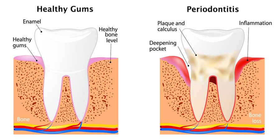 Periodontal Disease - The Center for High Tech Dentistry, New York Dentist