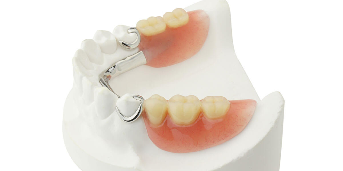 Removable Partial Denture - The Center for High Tech Dentistry, New York Dentist