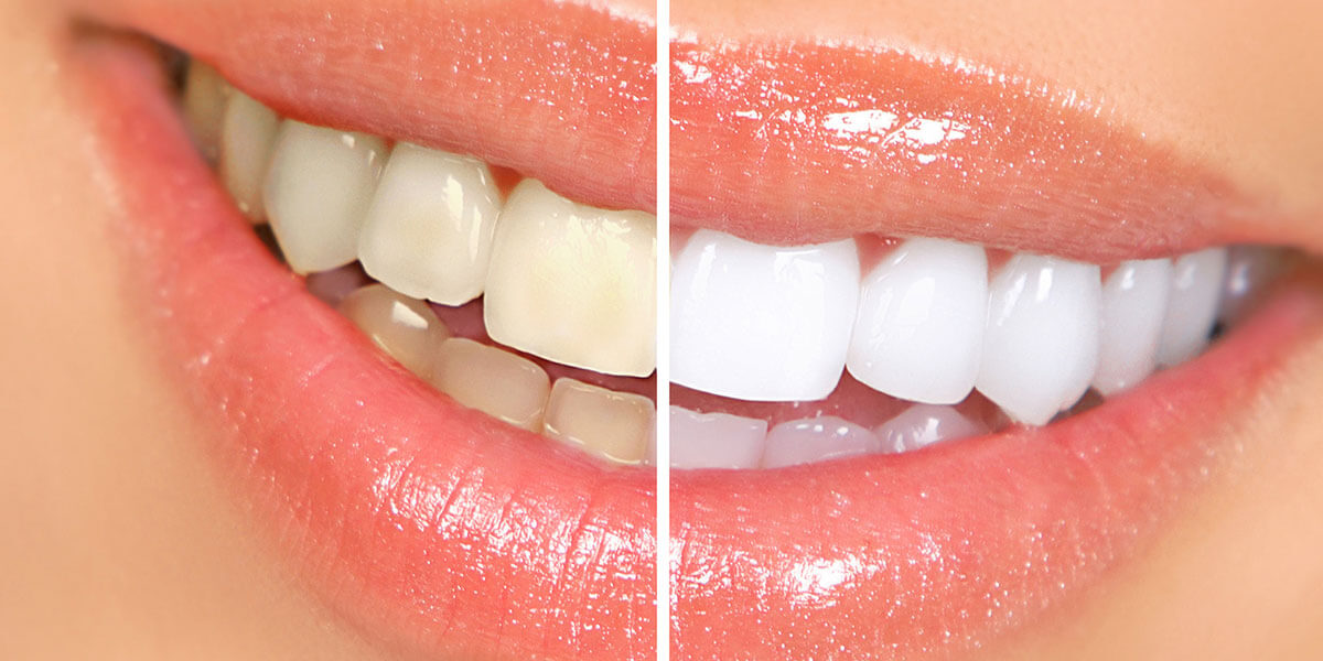 Whitening - The Center for High Tech Dentistry, New York Dentist