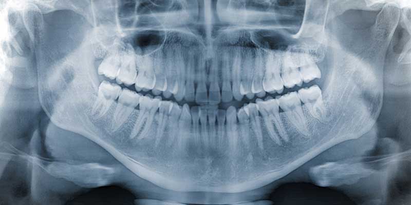 The Role of X-Rays in Periodontal Disease Diagnosis - The Center for High Tech Dentistry, New York Dentist