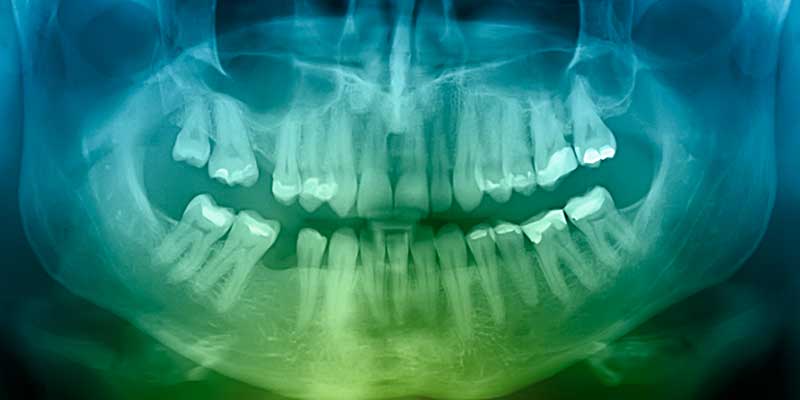 The Role of X-Rays in Periodontal Disease Diagnosis - The Center for High Tech Dentistry, New York Dentist