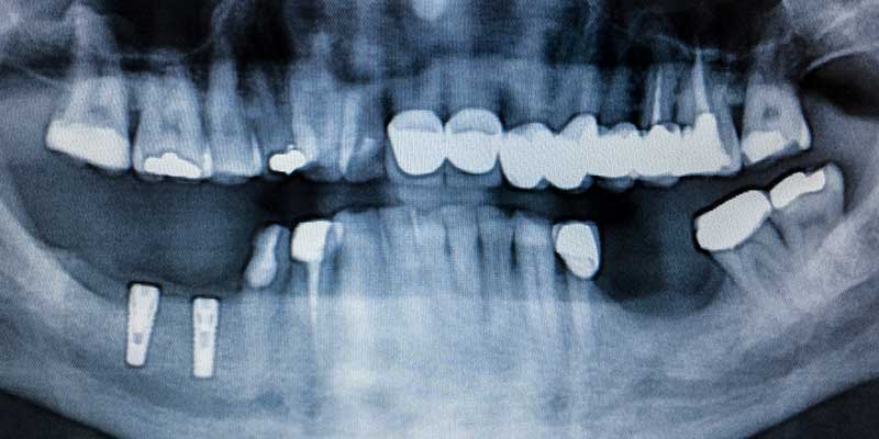 The Role of X-Rays in Periodontal Disease Diagnosis - The Center for High Tech Dentistry, New York Dentist