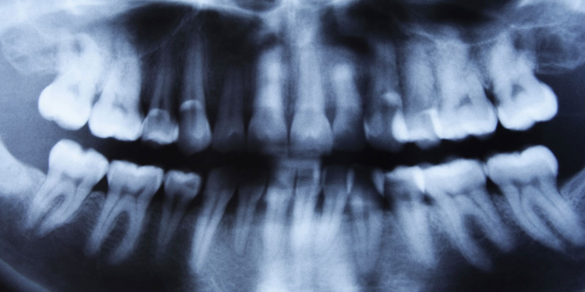 Good Dentistry Needs Good X-Rays - The Center for High Tech Dentistry, New York Dentist