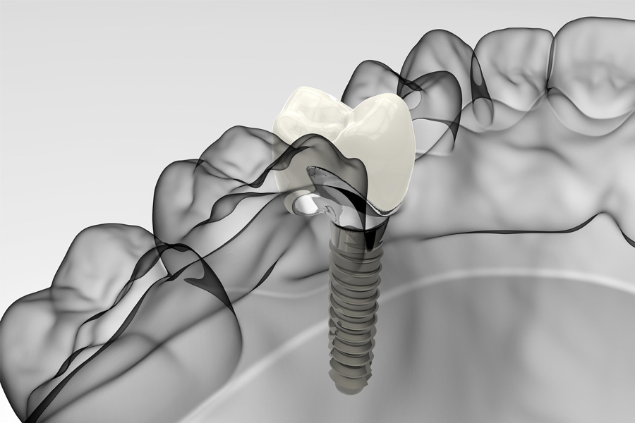 Dental Implants in Kaneohe