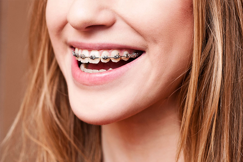 Orthodontics - Happy Tooth Dental, Woodland Hills Dentist