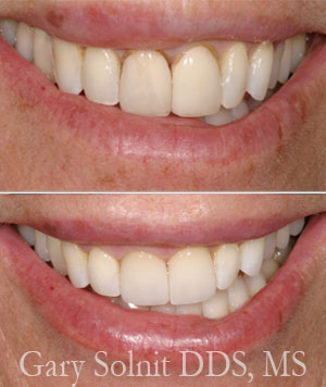 Porcelain Veneers Beverly Hills