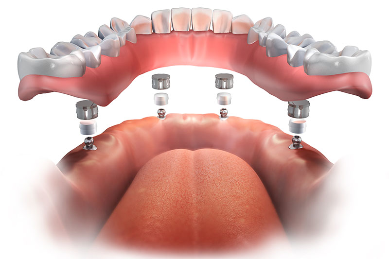 Implant Supported Dentures in Ponchatoula