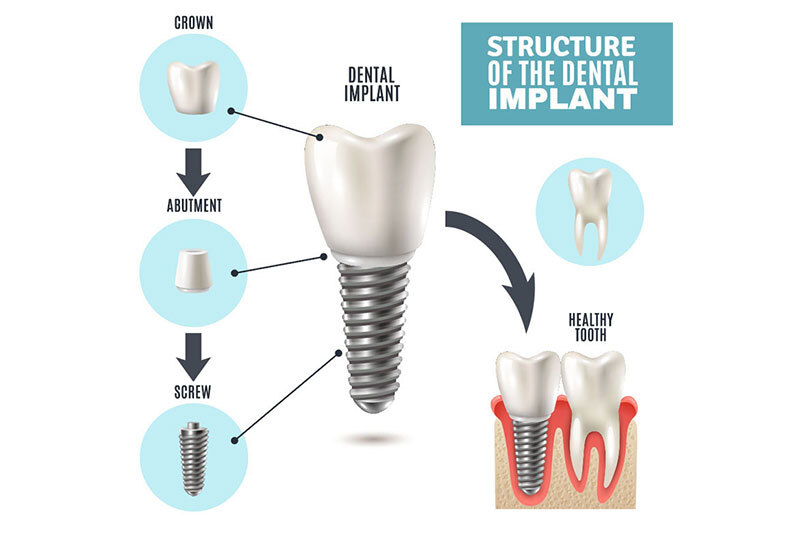 Single Tooth Replacement in Ponchatoula