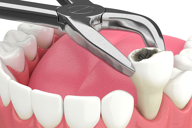 Tooth Extraction in Hinsdale