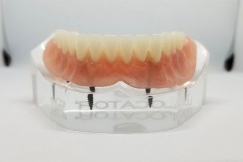 Snap-In Implant Dentures (Removable) in West Chester