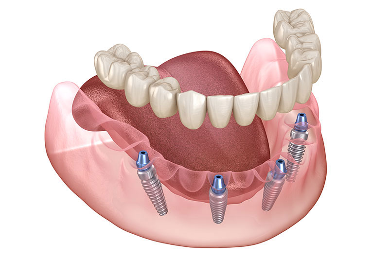 Full Arch Implants (Non-removable) in West Chester