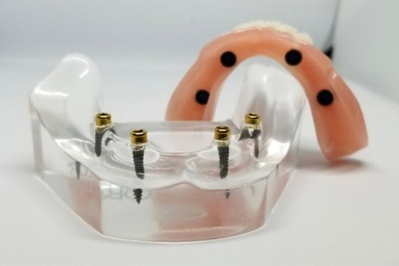 Snap-In Implant Dentures (Removable) in Cumming