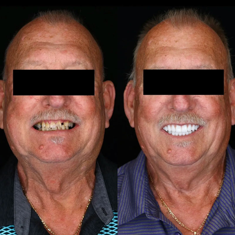 Dental Implant Before Afters in Cumming