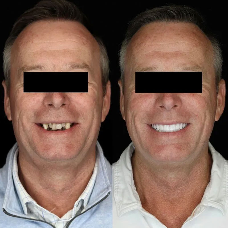 Dental Implant Before Afters in Cumming