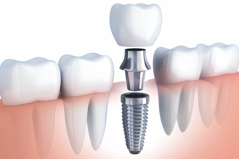 Single Tooth Implants & Bridge in Cumming