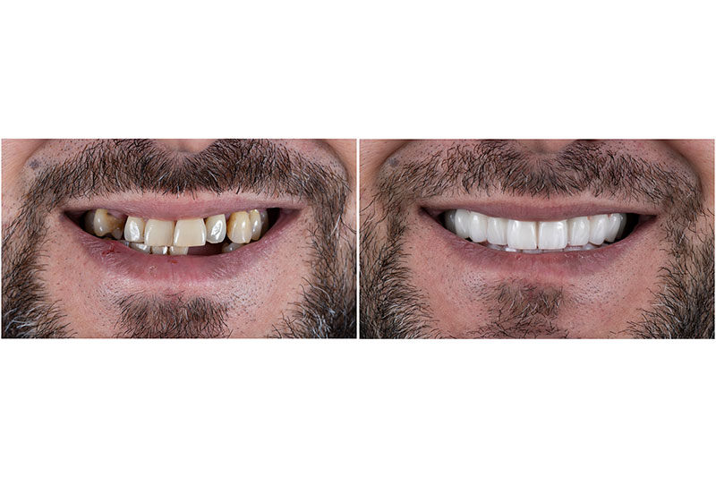 Dental Crowns in Parkville