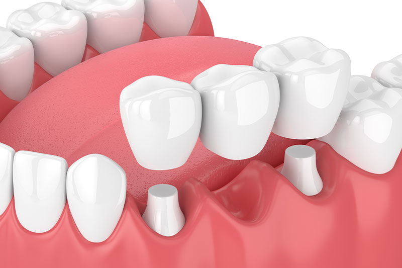 Dental Bridges in Waterford